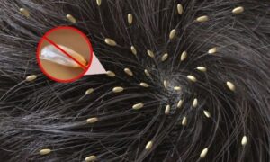 Mơ Thấy Con Chấy Có Ý Nghĩa Gì?